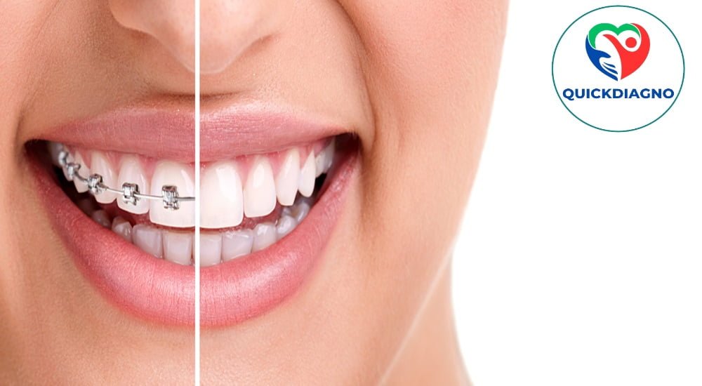 Dental braces