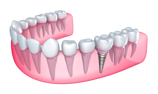 Dentalimplant_Book_ur_dentist