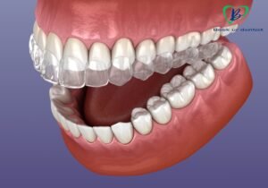 Invisalign Book Ur Dentist
