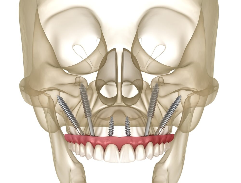 Zogamatic Implant