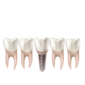 Book ur Dentist - Dental Implant