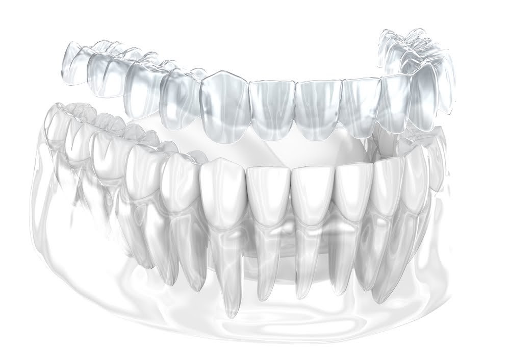 Transparent Braces