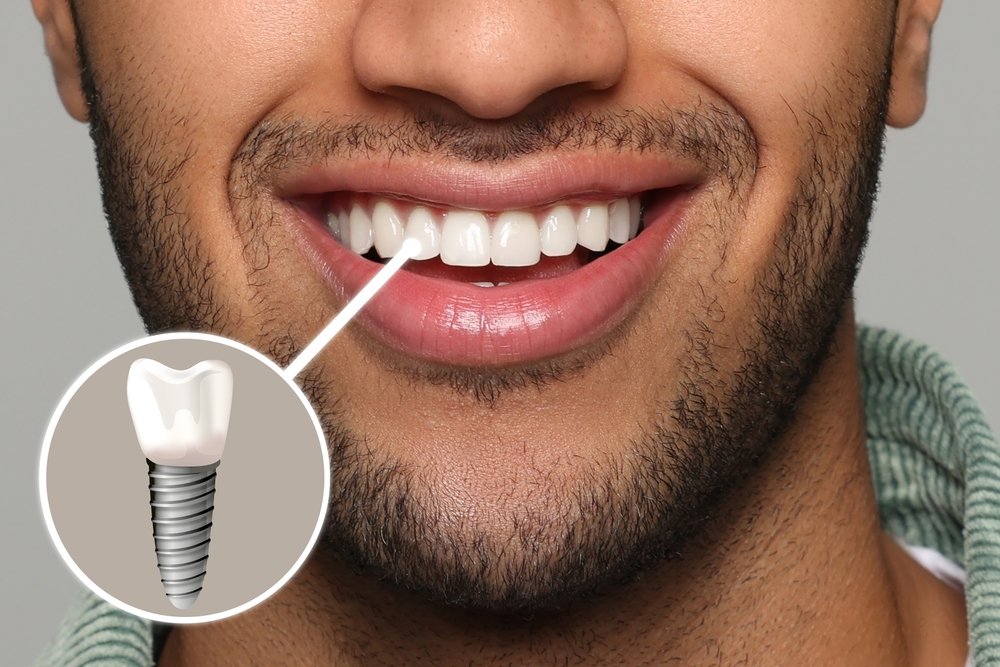 Dental Implant Men Book ur dentist