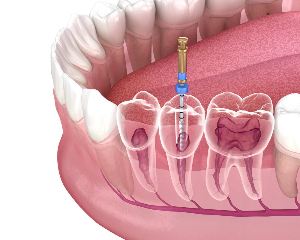Dental Root canal at affordable cost in Book ur dentist
