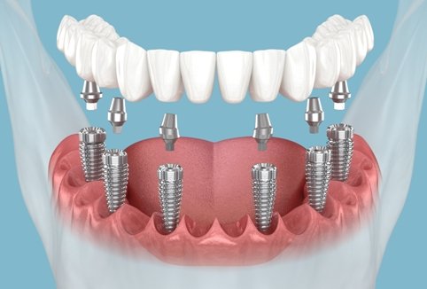denture and full mouth