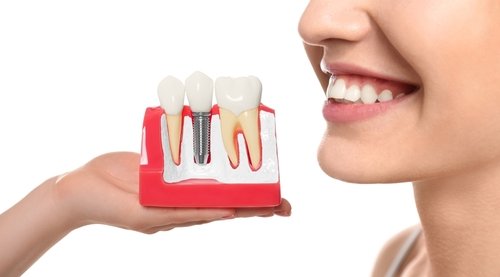 Book ur dentist Dental Implant