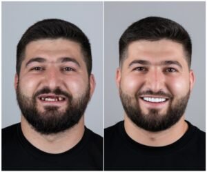 Before after Dental implant Book ur dentist