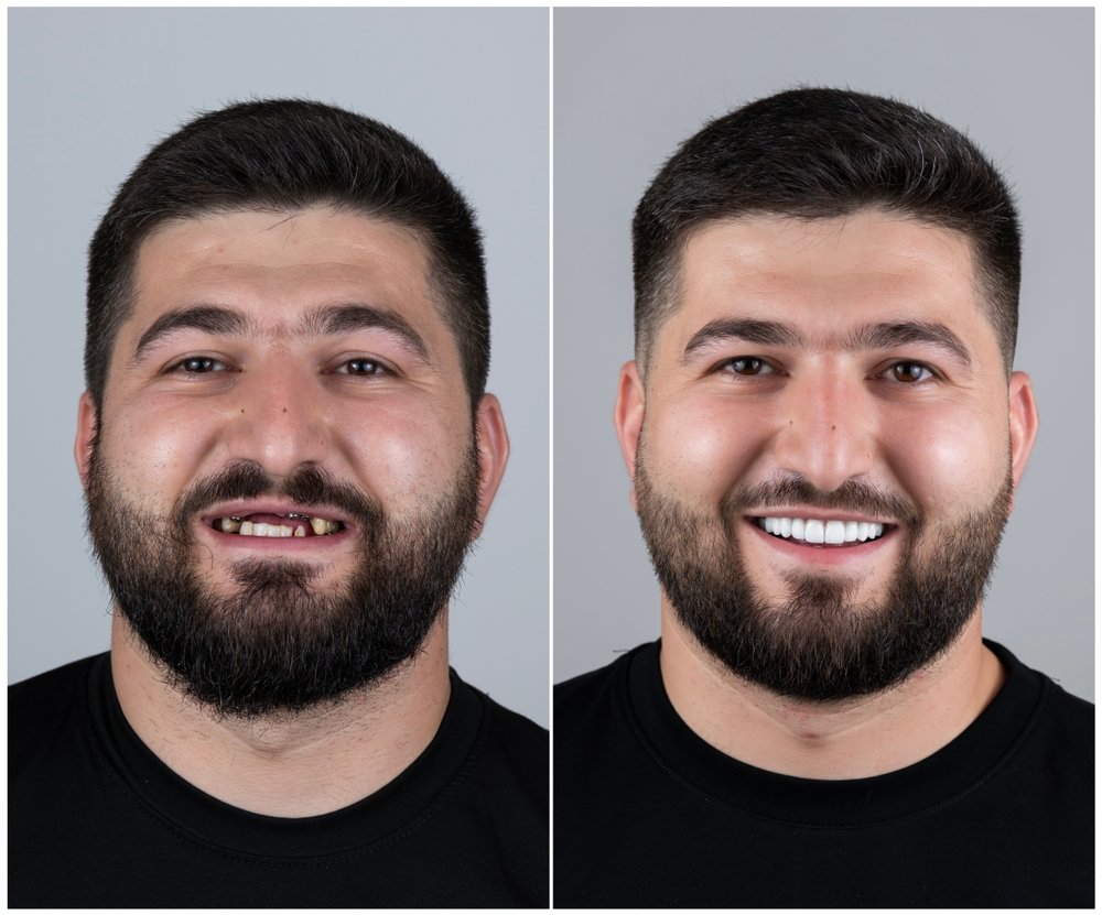 Before after Dental implant Book ur dentist
