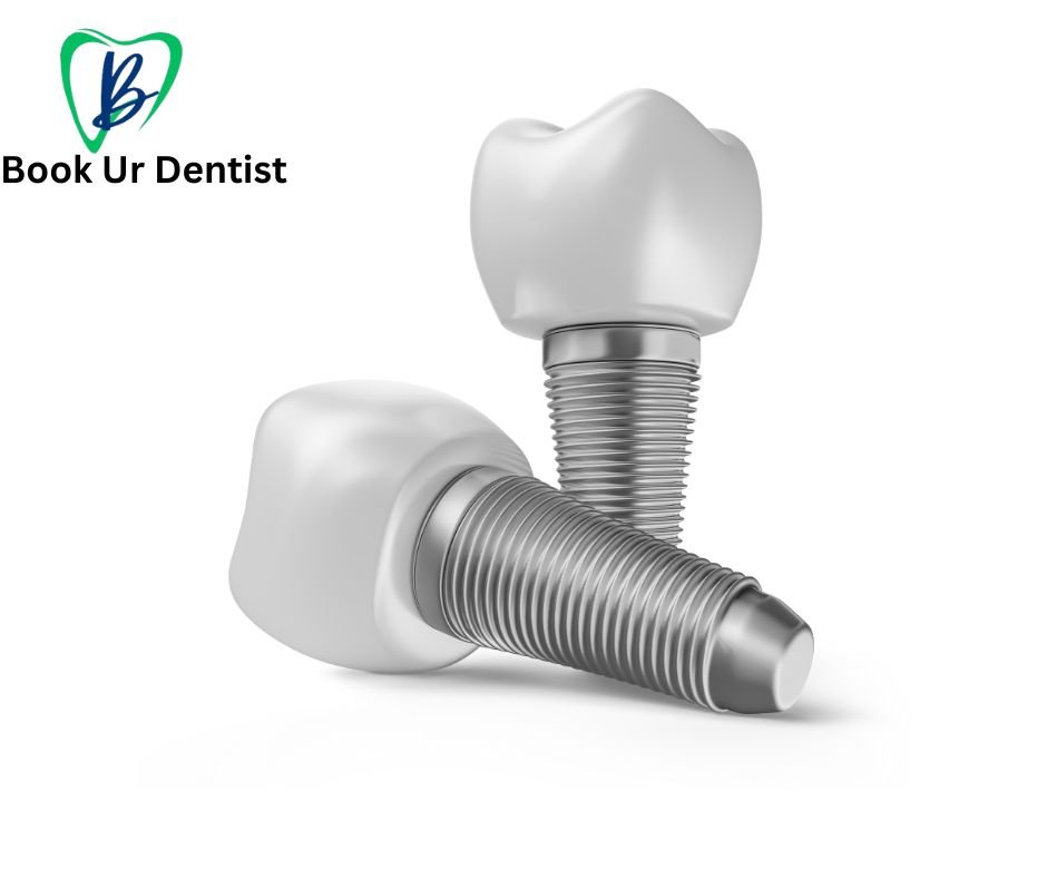 Affordable dental Implants