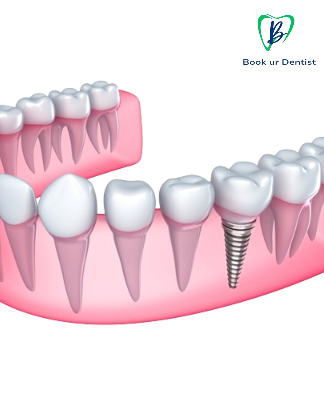 Book ur Dentist Affordble dental implant
